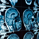 Illustration for article titled Rare neurological patient shows that self-awareness does not require a complex brain